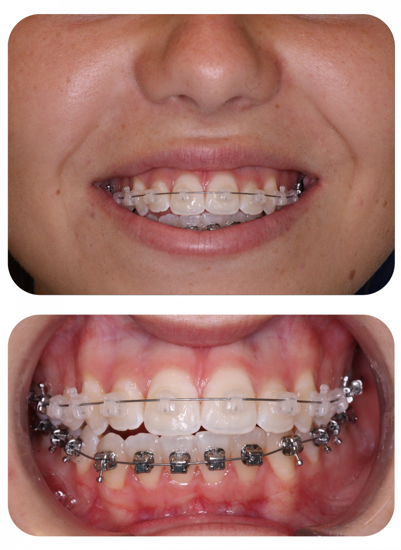 Ortodoncia para adultos Clínica Bucodental